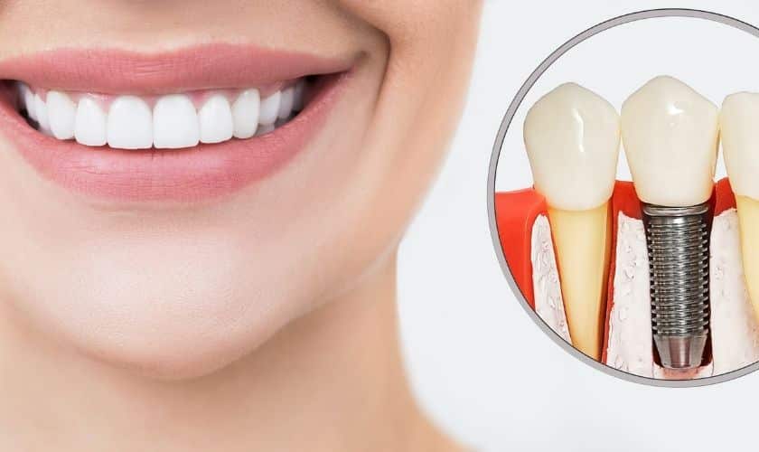 dental veneers in pragathi nagar