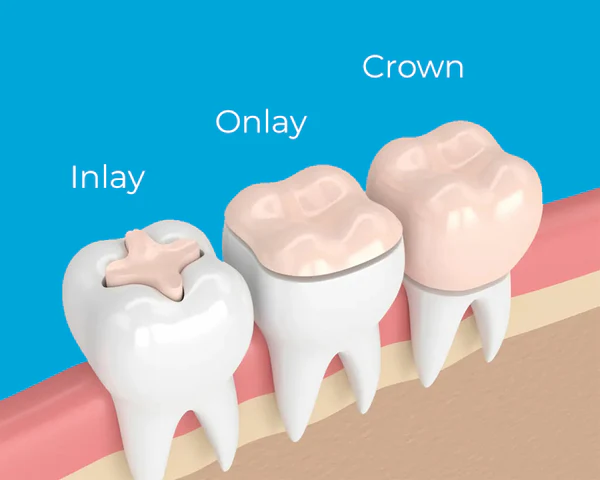 inlays and onlays