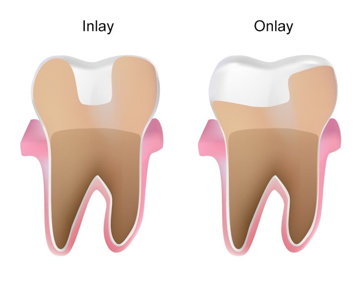 inlay and onlay