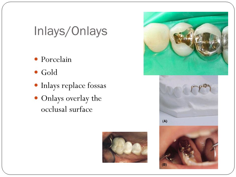 dental veneers in pragathi nagar