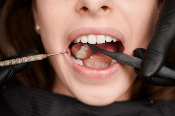 dental veneers in pragathi nagar