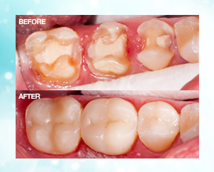 dental veneers in pragathi nagar