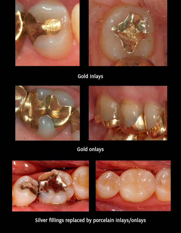 dental veneers in pragathi nagar