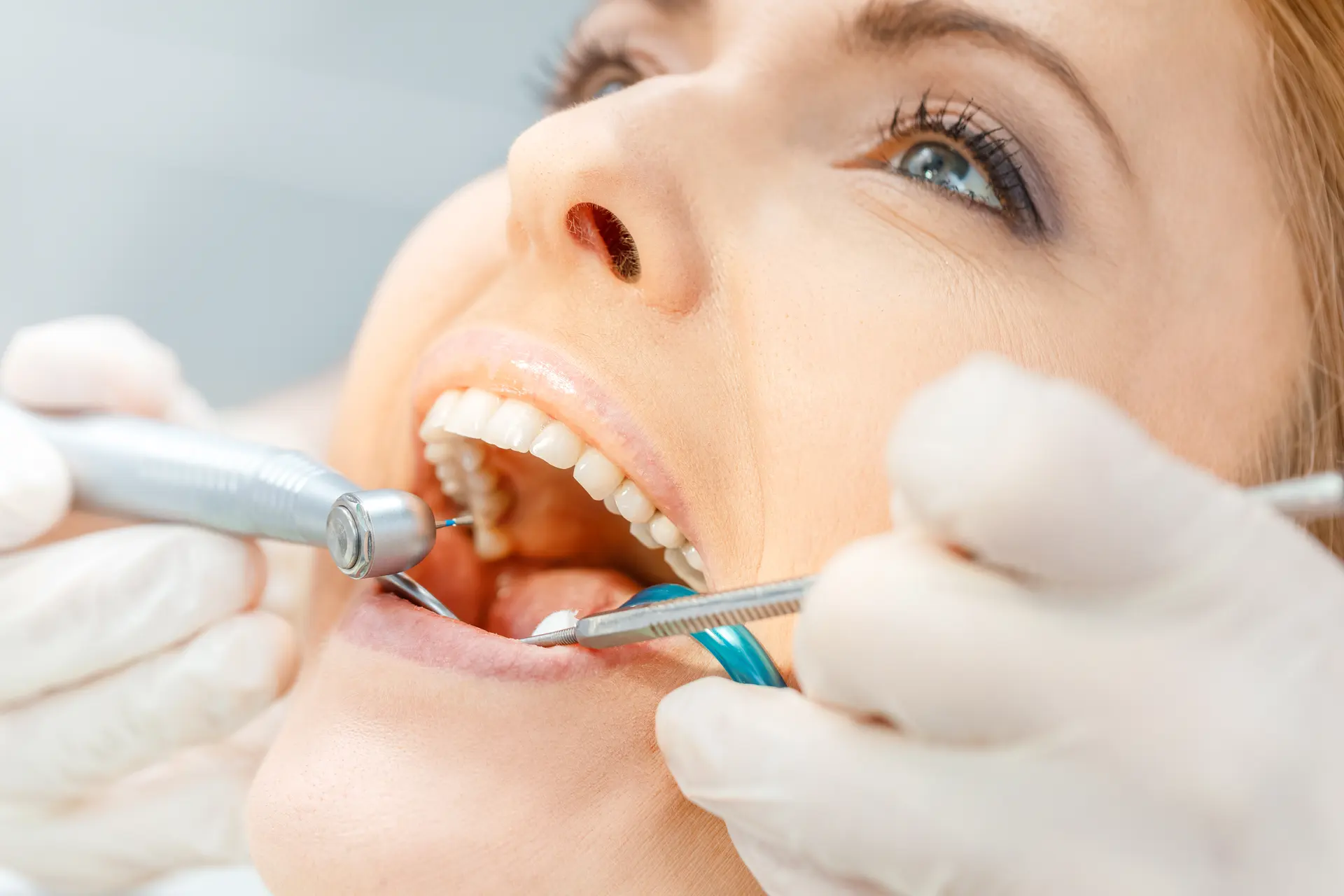 dental veneers in pragathi nagar