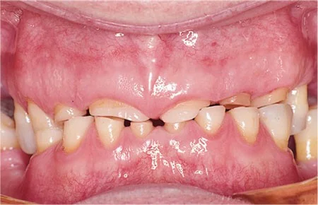 full mouth rehabilitation