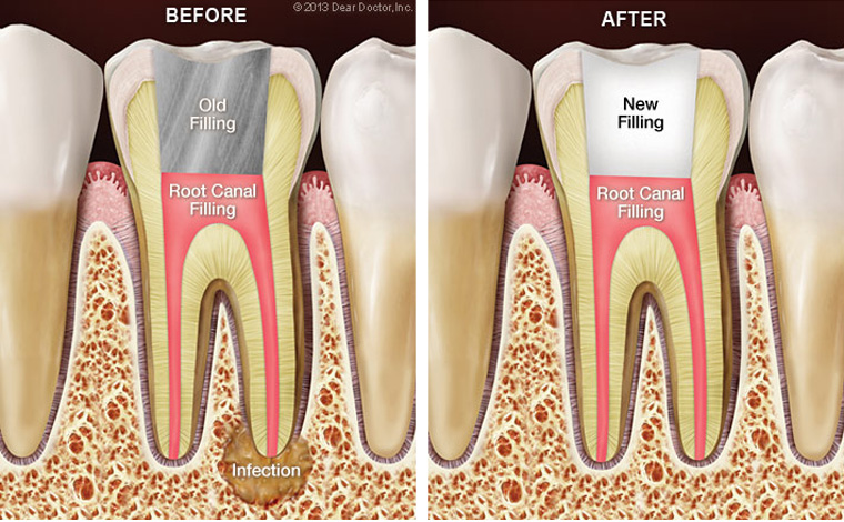 root canal
