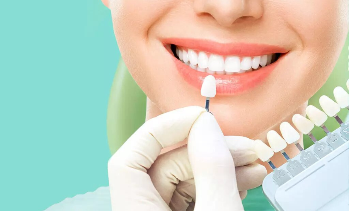 dental veneers in pragathi nagar