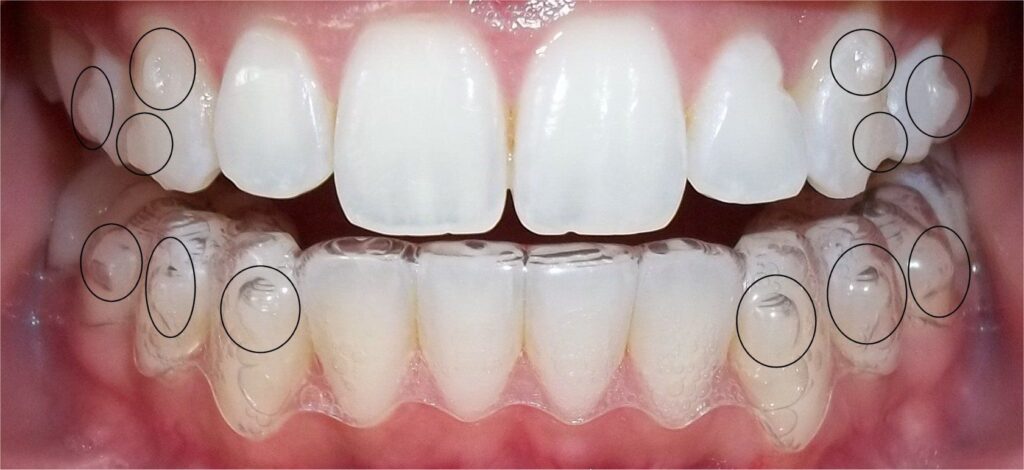 dental veneers in pragathi nagar