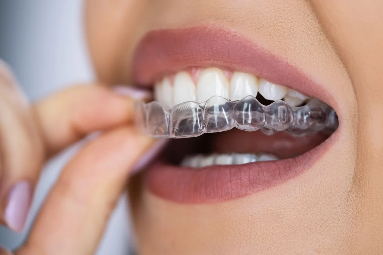 dental veneers in pragathi nagar