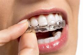 dental veneers in pragathi nagar