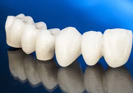 dental veneers in pragathi nagar