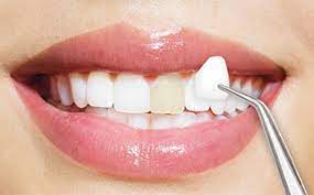 dental veneers in pragathi nagar