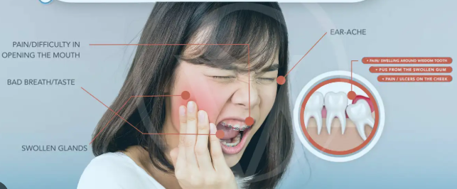 wisdom teeth