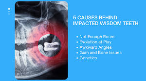 wisdom teeth