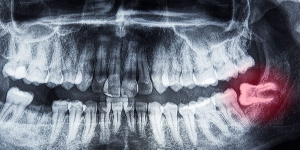 wisdom teeth
