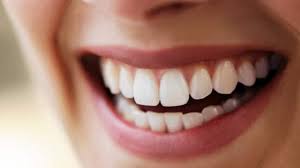 dental veneers in pragathi nagar