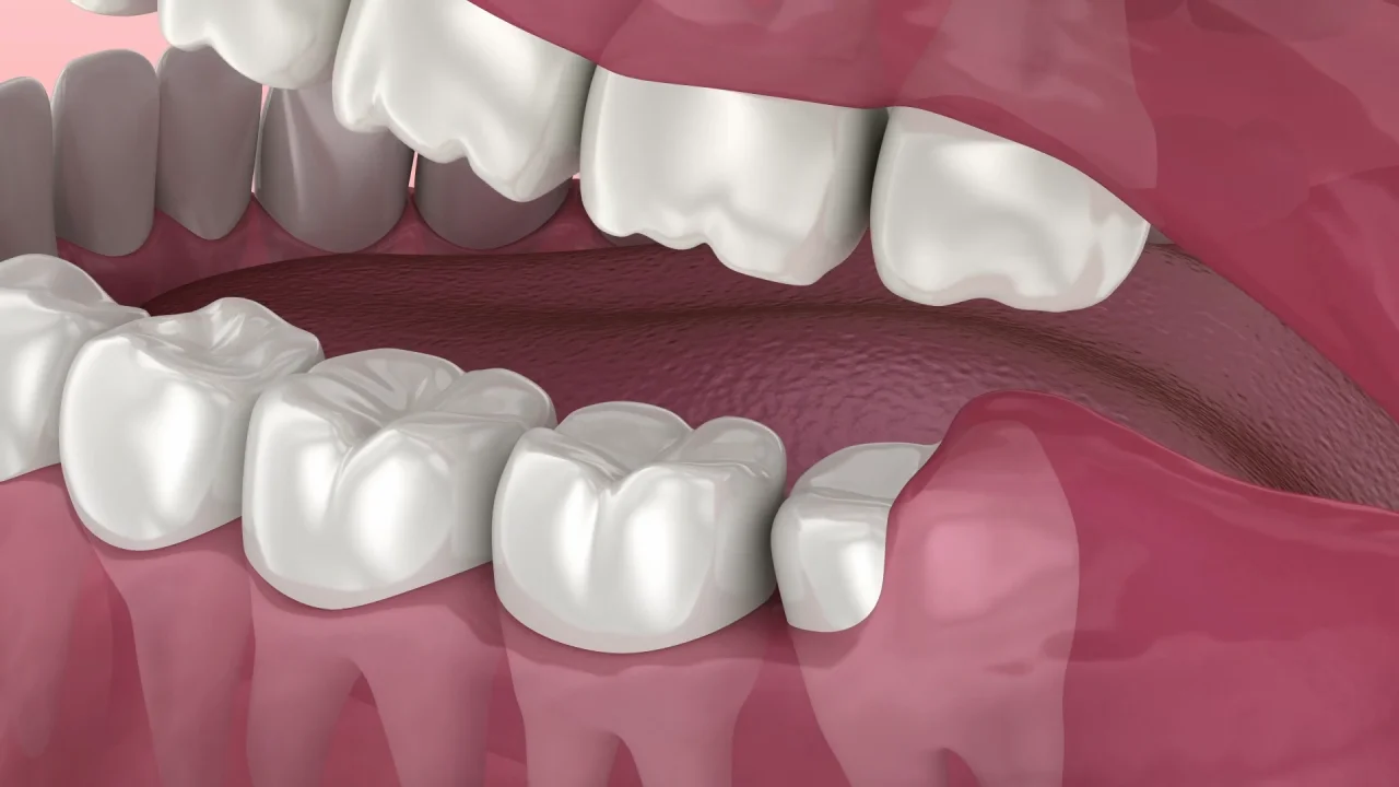 dental veneers in pragathi nagar