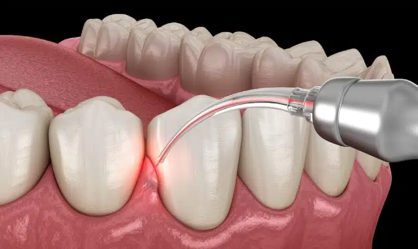 Laser-Gum-Disease-Treatment