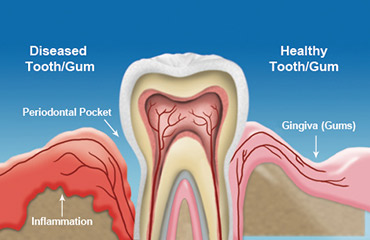 laser-gum-disease