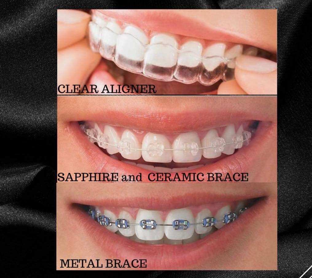 braces