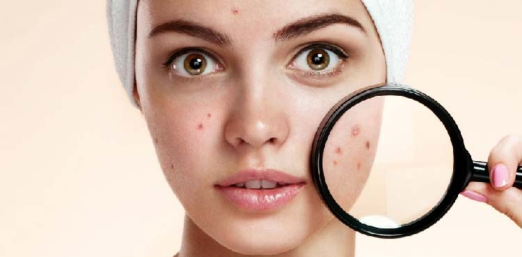 acne-treatment