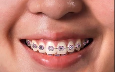 dental implants clinic india